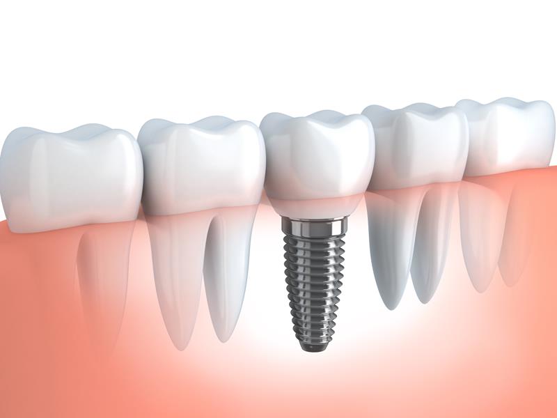 Dental Implants Woodside, NY