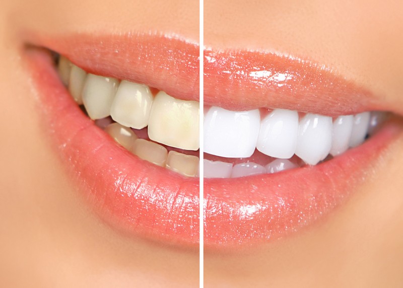 Teeth Whitening Woodside, NY